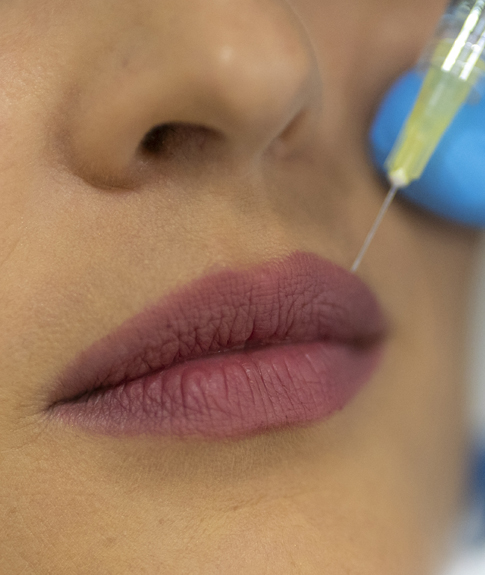 Aumento de labios